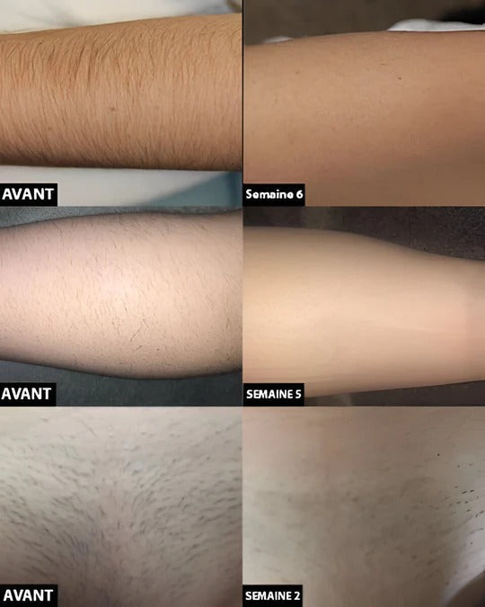 At-Home Laser Hair Removal Device for Full Body Use